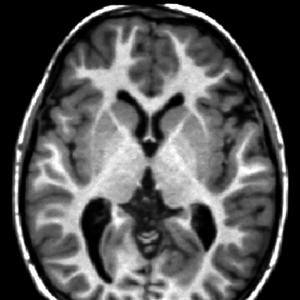 MRI T1 axial